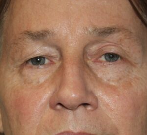 Eyelid Patient 21 - Before - 1 Thumbnail