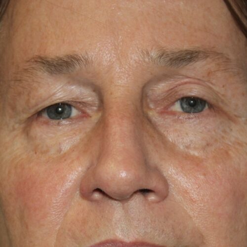 Eyelid Patient 21 - Before - 1