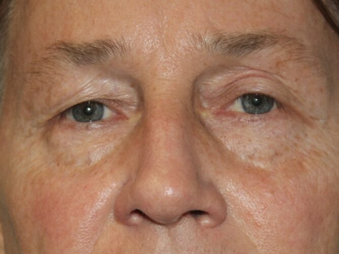 Eyelid Patient 21 - Before - 1