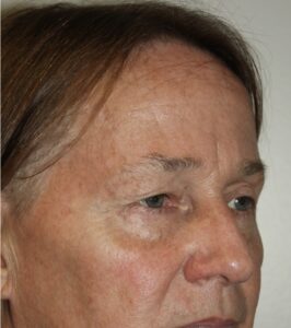 Eyelid Patient 21 - Before - 2 Thumbnail