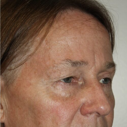 Eyelid Patient 21 - Before - 2