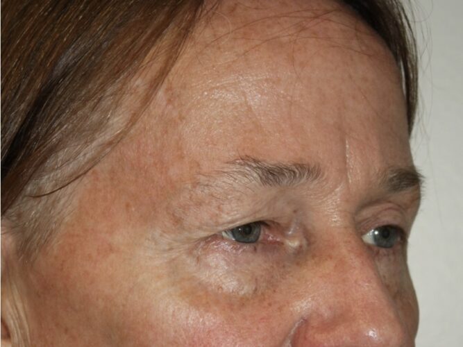 Eyelid Patient 21 - Before - 2