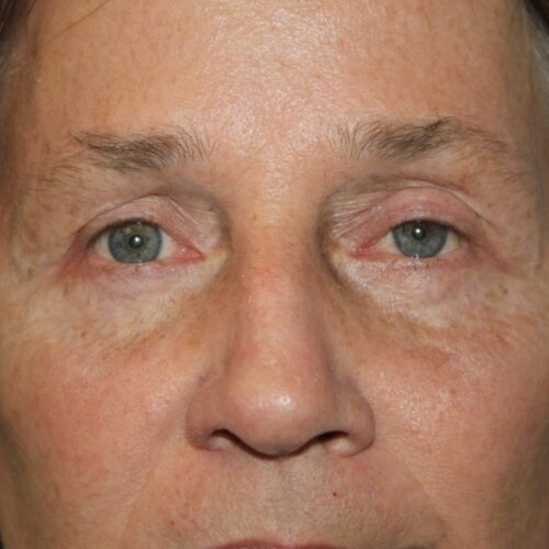 Eyelid Patient 21 - After - 1