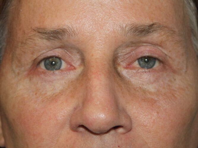 Eyelid Patient 21 - After - 1
