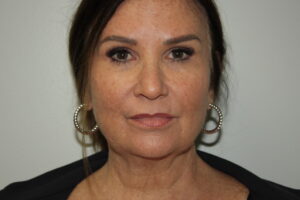 Female Facelift Patient 72 - Before - 2 Thumbnail