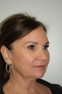 Female Facelift Patient 72 - Before - 1 Thumbnail