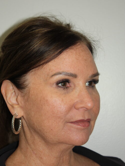 Female Facelift Patient 72 - Before - 1