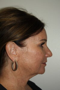 Female Facelift Patient 72 - Before - 3 Thumbnail