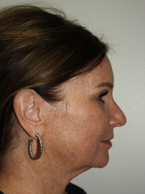 Female Facelift Patient 72 - Before - 3