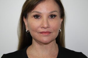 Female Facelift Patient 72 - After - 2 Thumbnail