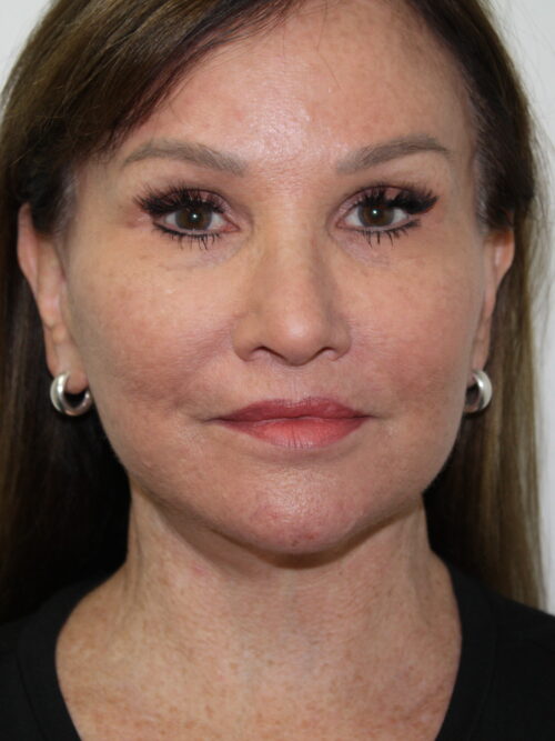 Female Facelift Patient 72 - After - 2