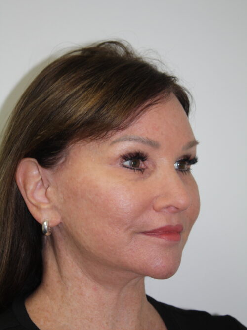 Female Facelift Patient 72 - After - 1