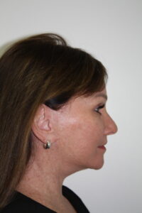 Female Facelift Patient 72 - After - 3 Thumbnail