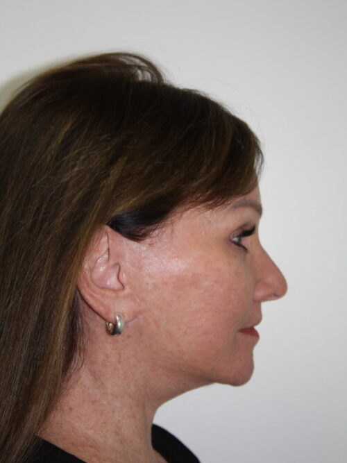 Female Facelift Patient 72 - After - 3