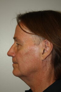 Male Facelift Patient 32 - Before - 2 Thumbnail