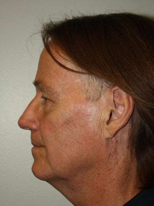 Male Facelift Patient 32 - Before - 2
