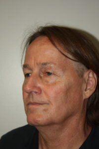 Male Facelift Patient 32 - Before - 1 Thumbnail
