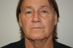 Male Facelift Patient 32 - Before - 3 Thumbnail