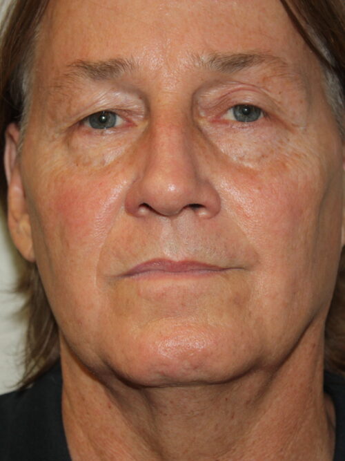 Male Facelift Patient 32 - Before - 3