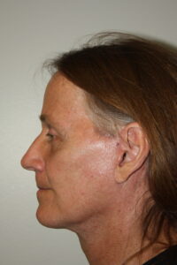 Male Facelift Patient 32 - After - 2 Thumbnail