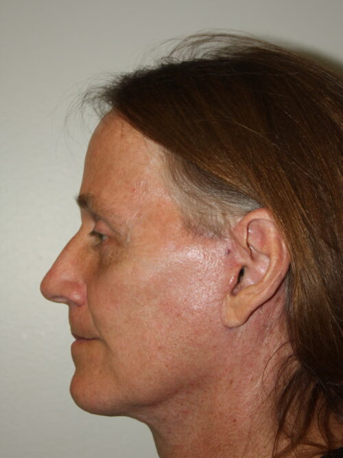 Male Facelift Patient 32 - After - 2