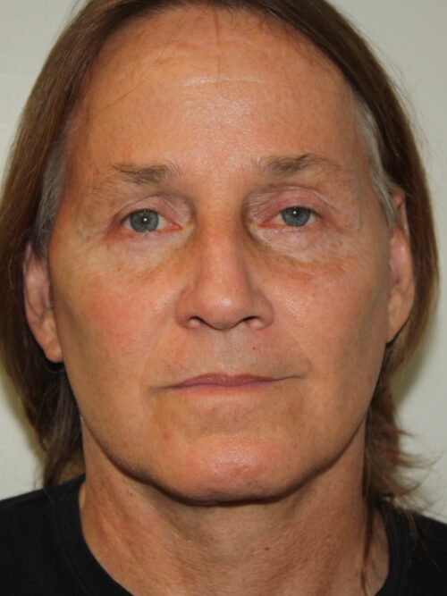 Male Facelift Patient 32 - After - 3