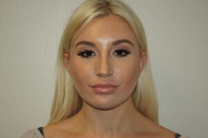 Rhinoplasty Patient 40 - After - 3 Thumbnail