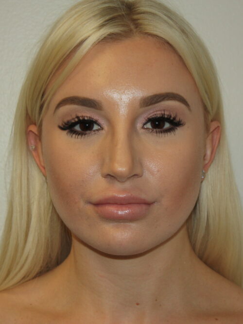 Rhinoplasty Patient 40 - After - 3