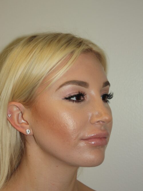 Rhinoplasty Patient 40 - After - 2