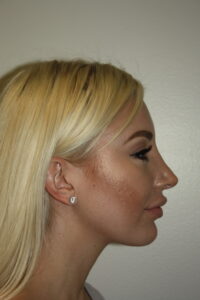 Rhinoplasty Patient 40 - After - 1 Thumbnail