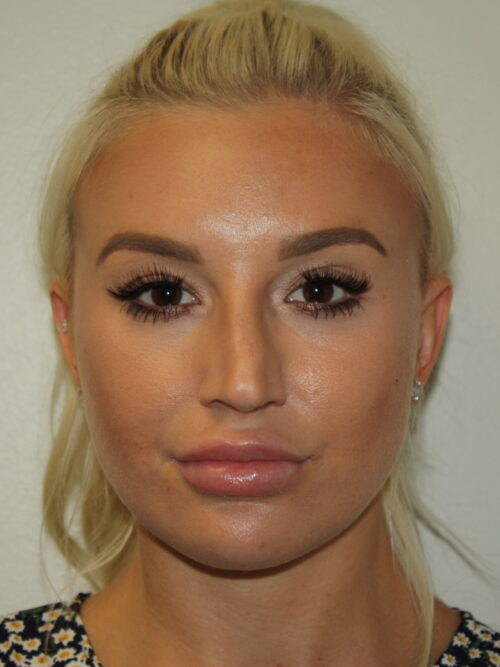 Rhinoplasty Patient 40 - Before - 3