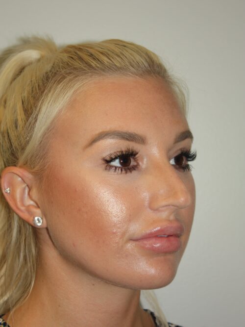 Rhinoplasty Patient 40 - Before - 2