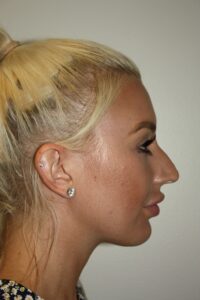 Rhinoplasty Patient 40 - Before - 1 Thumbnail