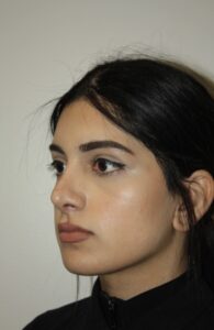 Rhinoplasty Patient 41 - After - 3 Thumbnail