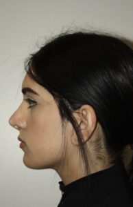 Rhinoplasty Patient 41 - After - 2 Thumbnail