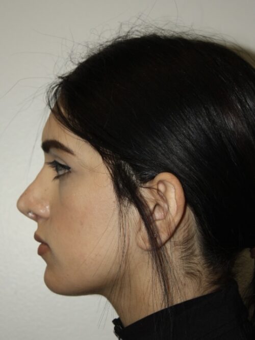 Rhinoplasty Patient 41 - After - 2