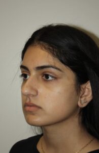 Rhinoplasty Patient 41 - Before - 3 Thumbnail