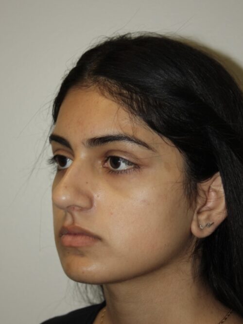 Rhinoplasty Patient 41 - Before - 3