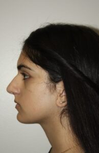 Rhinoplasty Patient 41 - Before - 2 Thumbnail