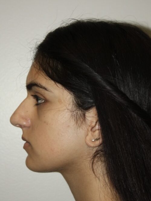 Rhinoplasty Patient 41 - Before - 2
