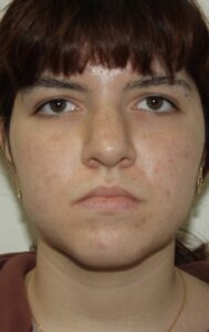 Rhinoplasty Patient 42 - Before - 1 Thumbnail