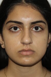 Rhinoplasty Patient 41 - Before - 1 Thumbnail