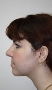 Rhinoplasty Patient 42 - After - 3 Thumbnail