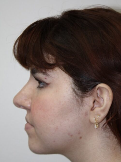 Rhinoplasty Patient 42 - After - 3