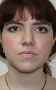 Rhinoplasty Patient 42 - After - 1 Thumbnail