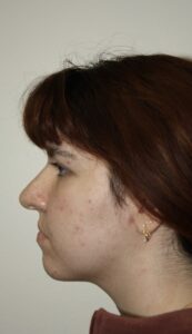Rhinoplasty Patient 42 - Before - 3 Thumbnail