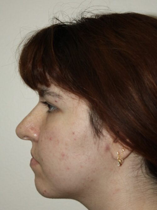Rhinoplasty Patient 42 - Before - 3