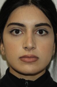 Rhinoplasty Patient 41 - After - 1 Thumbnail