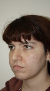 Rhinoplasty Patient 42 - Before - 2 Thumbnail