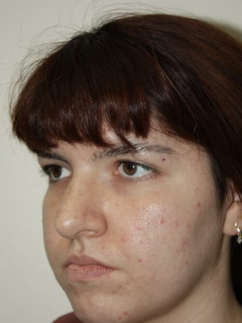 Rhinoplasty Patient 42 - Before - 2